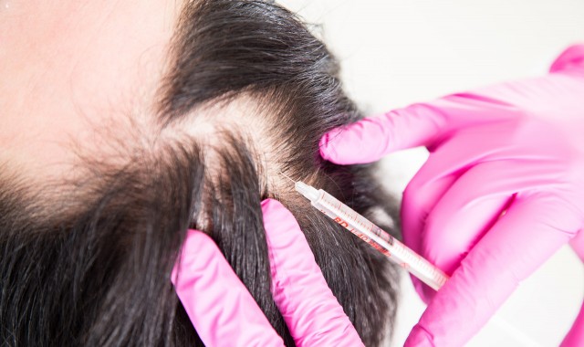 Mezoterapia igłowa w leczeniu łysienia